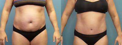 Tummy Tuck (Abdominoplasty) Before & After Gallery - Patient 123416 - Image 1