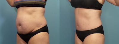 Tummy Tuck (Abdominoplasty) Before & After Gallery - Patient 123416 - Image 2