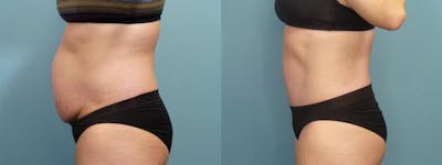 Tummy Tuck (Abdominoplasty) Before & After Gallery - Patient 123416 - Image 3