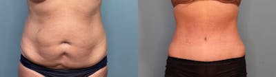 Tummy Tuck (Abdominoplasty) Before & After Gallery - Patient 152232 - Image 1