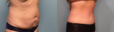 Tummy Tuck (Abdominoplasty) Before & After Gallery - Patient 152232 - Image 2