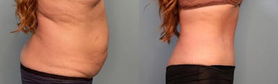 Tummy Tuck (Abdominoplasty) Before & After Gallery - Patient 152232 - Image 3