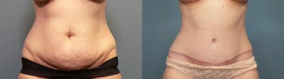 Tummy Tuck (Abdominoplasty) Before & After Gallery - Patient 355150 - Image 1