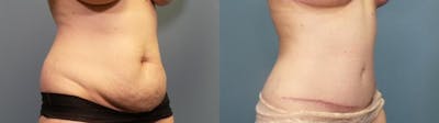 Tummy Tuck (Abdominoplasty) Before & After Gallery - Patient 355150 - Image 2