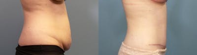 Tummy Tuck (Abdominoplasty) Before & After Gallery - Patient 355150 - Image 3