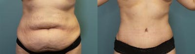 Tummy Tuck (Abdominoplasty) Before & After Gallery - Patient 326203 - Image 1