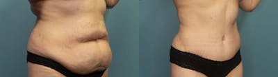 Tummy Tuck (Abdominoplasty) Before & After Gallery - Patient 326203 - Image 2