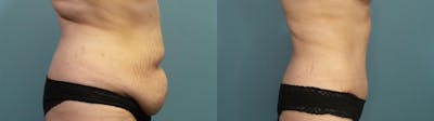Tummy Tuck (Abdominoplasty) Before & After Gallery - Patient 326203 - Image 3