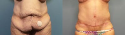 Tummy Tuck (Abdominoplasty) Before & After Gallery - Patient 186563 - Image 1