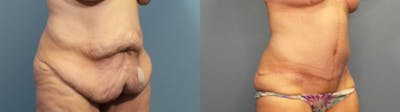 Tummy Tuck (Abdominoplasty) Before & After Gallery - Patient 186563 - Image 2