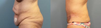 Tummy Tuck (Abdominoplasty) Before & After Gallery - Patient 186563 - Image 3