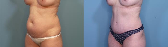 Tummy Tuck (Abdominoplasty) Before & After Gallery - Patient 386714 - Image 3