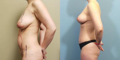 Tummy Tuck (Abdominoplasty) Before & After Gallery - Patient 385969 - Image 2