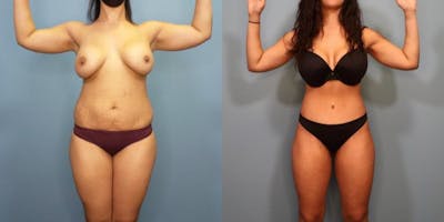 Tummy Tuck (Abdominoplasty) Before & After Gallery - Patient 278982 - Image 1
