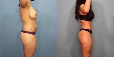 Tummy Tuck (Abdominoplasty) Before & After Gallery - Patient 278982 - Image 2