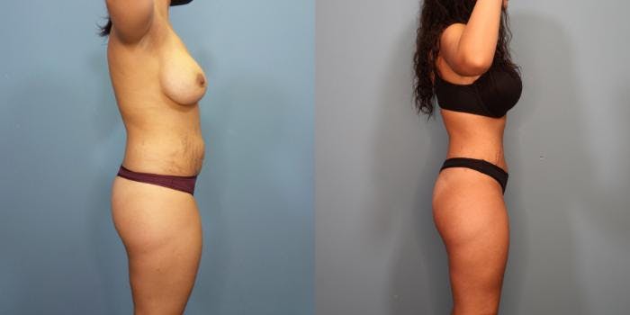 Tummy Tuck (Abdominoplasty) Before & After Gallery - Patient 278982 - Image 2