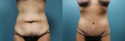 Tummy Tuck (Abdominoplasty) Before & After Gallery - Patient 290504 - Image 1
