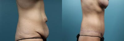 Tummy Tuck (Abdominoplasty) Before & After Gallery - Patient 290504 - Image 2