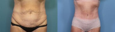 Tummy Tuck (Abdominoplasty) Before & After Gallery - Patient 451117 - Image 1
