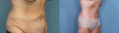 Tummy Tuck (Abdominoplasty) Before & After Gallery - Patient 451117 - Image 2
