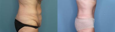 Tummy Tuck (Abdominoplasty) Before & After Gallery - Patient 451117 - Image 3
