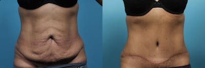 Tummy Tuck (Abdominoplasty) Before & After Gallery - Patient 318809 - Image 1
