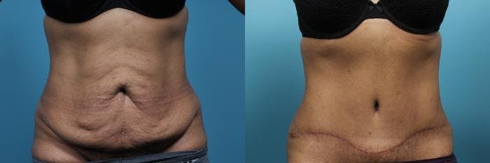 Tummy Tuck (Abdominoplasty) Before & After Gallery - Patient 318809 - Image 1