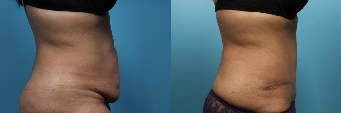Tummy Tuck (Abdominoplasty) Before & After Gallery - Patient 318809 - Image 2