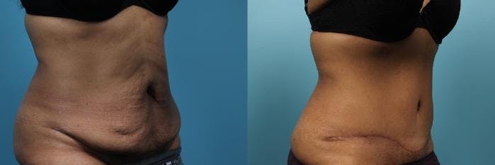 Tummy Tuck (Abdominoplasty) Before & After Gallery - Patient 318809 - Image 3