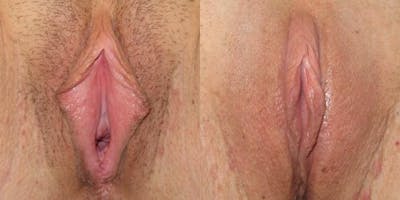 Labiaplasty Before & After Gallery - Patient 387291 - Image 1