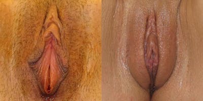 Labiaplasty Before & After Gallery - Patient 194285 - Image 1