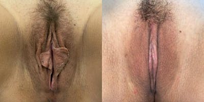 Labiaplasty Before & After Gallery - Patient 412716 - Image 1