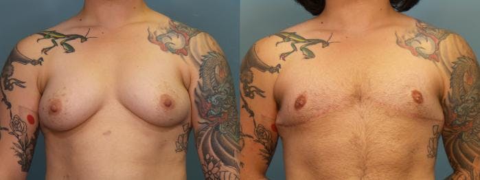 Gender Affirming Top Surgery Before & After Gallery - Patient 314350 - Image 1