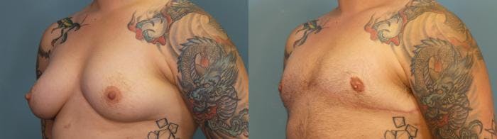 Gender Affirming Top Surgery Before & After Gallery - Patient 314350 - Image 2