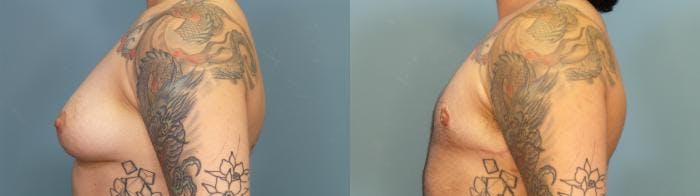 Gender Affirming Top Surgery Before & After Gallery - Patient 314350 - Image 3