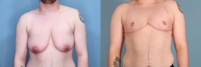 Gender Affirming Top Surgery Before & After Gallery - Patient 411768 - Image 1