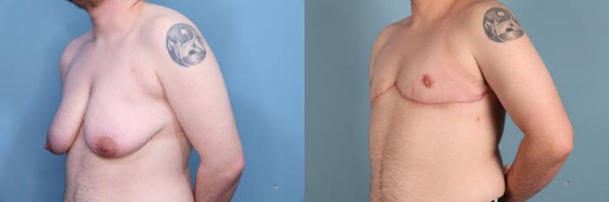 Gender Affirming Top Surgery Before & After Gallery - Patient 411768 - Image 2