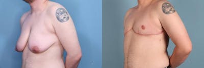 Gender Affirming Top Surgery Before & After Gallery - Patient 411768 - Image 2