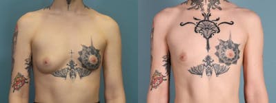 Gender Affirming Top Surgery Before & After Gallery - Patient 150755 - Image 1
