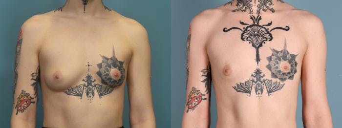 Gender Affirming Top Surgery Before & After Gallery - Patient 150755 - Image 1