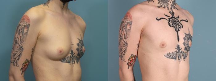Gender Affirming Top Surgery Before & After Gallery - Patient 150755 - Image 2