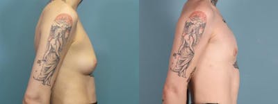 Gender Affirming Top Surgery Before & After Gallery - Patient 150755 - Image 3