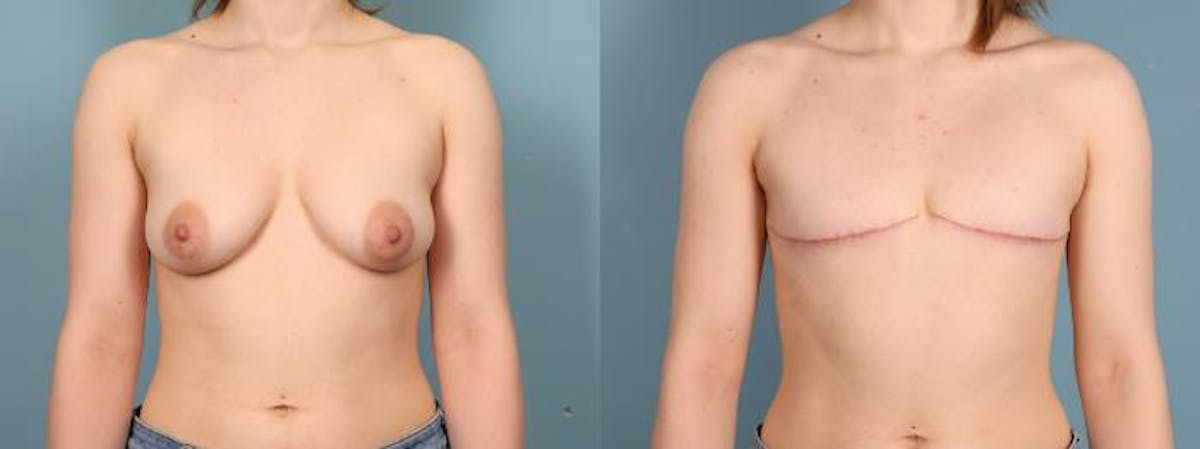 Gender Affirming Top Surgery Before & After Gallery - Patient 337521 - Image 1