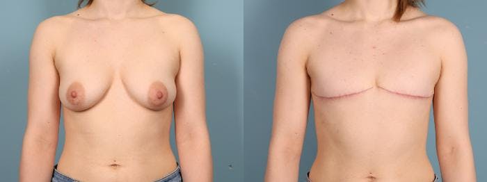 Gender Affirming Top Surgery Before & After Gallery - Patient 337521 - Image 1