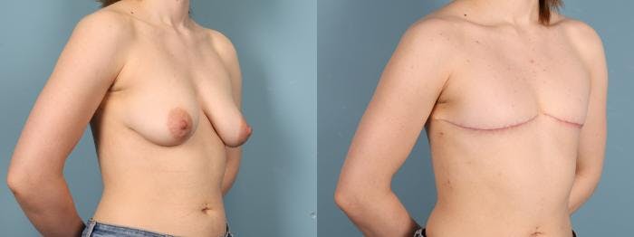Gender Affirming Top Surgery Before & After Gallery - Patient 337521 - Image 2
