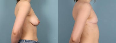 Gender Affirming Top Surgery Before & After Gallery - Patient 337521 - Image 3