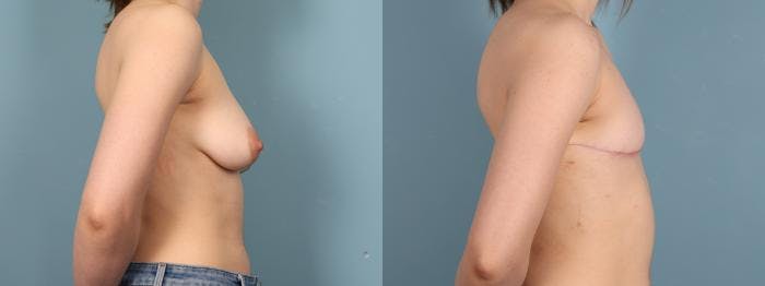 Gender Affirming Top Surgery Before & After Gallery - Patient 337521 - Image 3