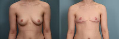 Gender Affirming Top Surgery Before & After Gallery - Patient 134529 - Image 1