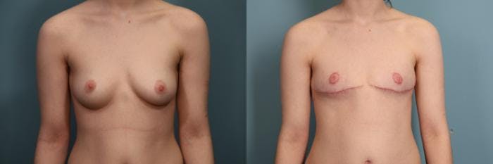 Gender Affirming Top Surgery Before & After Gallery - Patient 134529 - Image 1