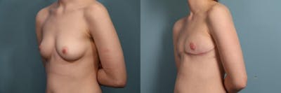 Gender Affirming Top Surgery Before & After Gallery - Patient 134529 - Image 2